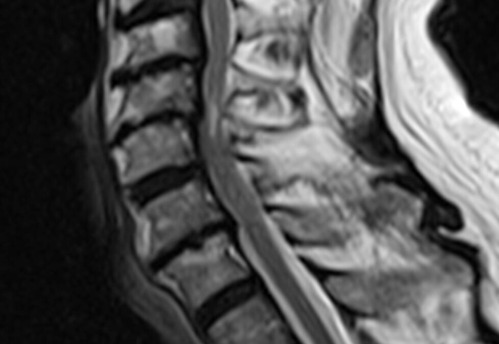 La myélopathie cervicarthrosique