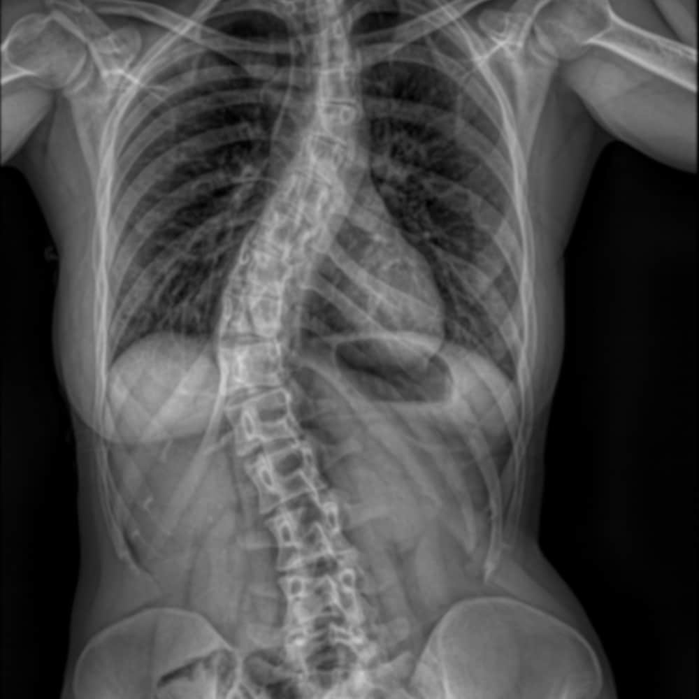 scoliose idiopathique