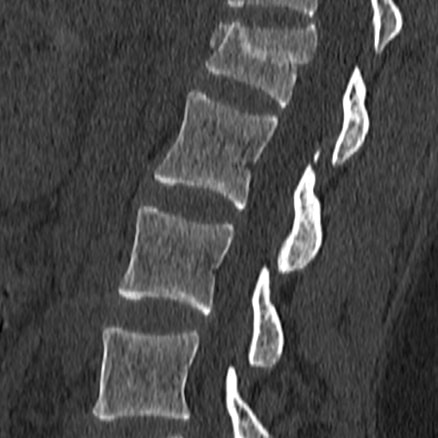 fracture
